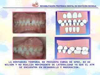 REHABILITACIÓN PROTÉSICA DENTAL EN DENTICIÓN DECIDUA LA DENTADURA TEMPORAL NO PRESENTA CURVA DE SPEE, NI DE WILSON Y NO REALIZA MOVIMIENTO DE LATERALIDAD YA QUE EL ATM SE ENCUENTRA EN DESARROLLO Y MADURACION. Escobar F. Odontología Pediátrica: 2ª Ed. Chile: Amolca; 2004.   