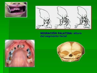MIGRACIÓN PALATINA : altura del segmento facial 