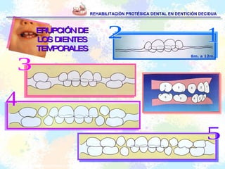 REHABILITACIÓN PROTÉSICA DENTAL EN DENTICIÓN DECIDUA 1 4 5 2 ERUPCIÓN DE LOS DIENTES TEMPORALES 3 Escobar F. Odontología Pediátrica: 2ª Ed. Chile: Amolca; 2004.  6m. a 12m. 