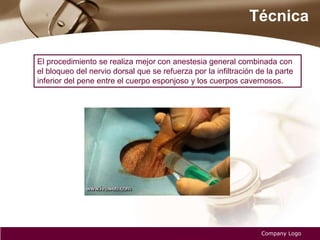 Técnica
Company Logo
El procedimiento se realiza mejor con anestesia general combinada con
el bloqueo del nervio dorsal que se refuerza por la infiltración de la parte
inferior del pene entre el cuerpo esponjoso y los cuerpos cavernosos.
 