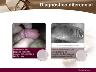 Diagnóstico diferencial
Company Logo
Inflamación del
prepucio (balanitis)
debido, por ejemplo, a
la infección.
hinchazón causada por
una picadura de
insecto. En tales casos,
la glande no es visible.
 