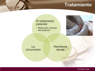 Tratamiento
Company Logo
El tratamiento
estándar
• Reducción manual
del prepucio
Hendidura
dorsal
La
circuncisión
 