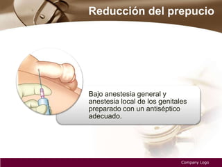 Reducción del prepucio
Company Logo
Bajo anestesia general y
anestesia local de los genitales
preparado con un antiséptico
adecuado.
 