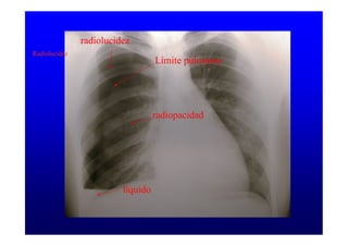 Radiolucidez
Límite pulmonar
radiolucidez
radiopacidad
líquido
 