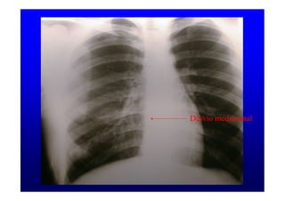 Desvío mediastinal
 