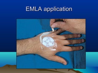 EMLA applicationEMLA application
 