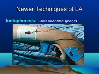 Newer Techniques of LANewer Techniques of LA
Iontophoresis: Lidocaine-soaked sponges
 