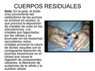 CUERPOS RESIDUALES
Gota. En la gota, el ácido
úrico proveniente del
catabolismo de las purinas
se produce en exceso, lo
que provoca la deposición
de cristales de urato en las
articulaciones. Los
cristales son fagocitados
por las células y se
acumulan en los lisosomas
secundarios; estos
cristales provocan la rotura
de dichas vacuolas con la
consiguiente liberación de
enzimas lisosómicos en el
citosol que causa la
digestión de componentes
celulares, la liberación de
sustancias de la célula y la
autolisis celular.
 