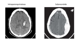 Intraparenquimatoso Subaracnóide
 