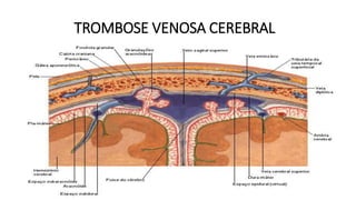 TROMBOSE VENOSA CEREBRAL
Seios venosos/Seios durais/Seios cerebrais
Canais venosos encontrados entre a dura-máter no cérebro.
Recebem o líquor do espaço subaracnóide através de saculações/granulações. (seio sagital superior)
Recebem sangue das veias internas e externas do cérebro
 