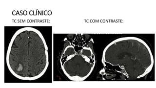 CASO CLÍNICO
TC SEM CONTRASTE: TC COM CONTRASTE:
 