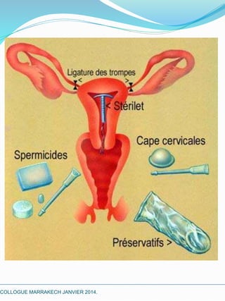 La contraception ver 2 | PDF