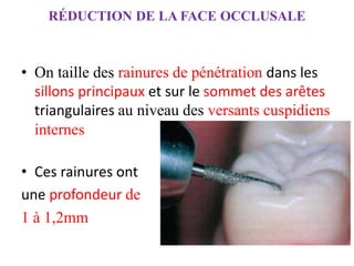 RÉDUCTION DE LA FACE OCCLUSALE
• On taille des rainures de pénétration dans les
sillons principaux et sur le sommet des arêtes
triangulaires au niveau des versants cuspidiens
internes
• Ces rainures ont
une profondeur de
1 à 1,2mm
 