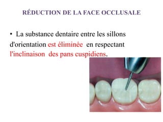 RÉDUCTION DE LA FACE OCCLUSALE
• La substance dentaire entre les sillons
d'orientation est éliminée en respectant
l'inclinaison des pans cuspidiens.
 