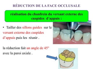 RÉDUCTION DE LA FACE OCCLUSALE
• Tailler des sillons guides sur le
versant externe des cuspides
d’appuis puis les réunir .
la réduction fait un angle de 45°
avec la paroi axiale .
réalisation du chanfrein du versant externe des
cuspides d’appuis :
 