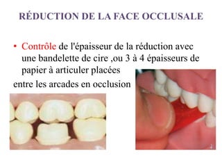RÉDUCTION DE LA FACE OCCLUSALE
• Contrôle de l'épaisseur de la réduction avec
une bandelette de cire ,ou 3 à 4 épaisseurs de
papier à articuler placées
entre les arcades en occlusion
 