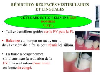 RÉDUCTION DES FACES VESTIBULAIRES
ET LINGUALES
• Tailler des sillons guides sur la FV puis la FL
• Balayage du mur par un mouvement
de va et vient de la fraise pour réunir les sillons
• La fraise à congé permet
simultanément la réduction de la
FV et la réalisation d'une limite
en forme de congé.
CETTE RÉDUCTION ÉLIMINE LES
BOMBÉS
V ET L
 