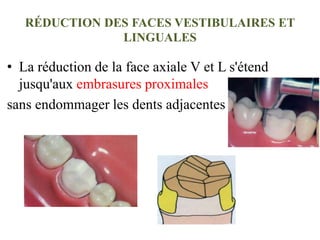 RÉDUCTION DES FACES VESTIBULAIRES ET
LINGUALES
• La réduction de la face axiale V et L s'étend
jusqu'aux embrasures proximales
sans endommager les dents adjacentes
 
