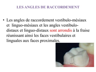 LES ANGLES DE RACCORDEMENT
• Les angles de raccordement vestibulo-mésiaux
et linguo-mésiaux et les angles vestibulo-
distaux et linguo-distaux sont arrondis à la fraise
réunissant ainsi les faces vestibulaires et
linguales aux faces proximales.
 