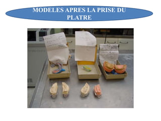 MODELES APRES LA PRISE DU
PLATRE
 