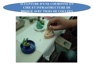 SCULPTURE D’UNE COURONNE EN
CIRE ET INFRASTRUCTURE DE
BRIDGE AVEC TIGES DE COULÉES
 