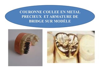 COURONNE COULEE EN METAL
PRECIEUX ET ARMATURE DE
BRIDGE SUR MODÈLE
 