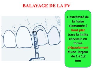 BALAYAGE DE LA FV
L'extrémité de
la fraise
diamantée à
bout plat
trace la limite
cervicale en
forme
d'épaulement
d’une largeur
de 1 à 1,2
mm
 