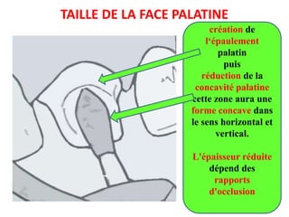 TAILLE DE LA FACE PALATINE
création de
l‘épaulement
palatin
puis
réduction de la
concavité palatine
cette zone aura une
forme concave dans
le sens horizontal et
vertical.
L'épaisseur réduite
dépend des
rapports
d'occlusion
 