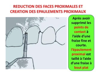 REDUCTION DES FACES PROXIMALES ET
CREATION DES EPAULEMENTS PROXIMAUX
Après avoir
supprimé les
points de
contact à
l’aide d’une
fraise fine et
courte.
l’épaulement
proximal est
taillé à l’aide
d’une fraise à
bout plat
 