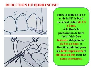 REDUCTION DU BORD INCISIF
après la taille de la FV
et de la FP, le bord
incisif est réduit de 1.5
à 2mm.
À la fin de la
préparation, le bord
incisif doit être
biseauté obliquement,
de bas en haut en
direction palatine pour
les dents supérieures et
du haut en bas pour les
dents inférieures.
 