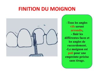 FINITION DU MOIGNON
-Tous les angles
vifs seront
arrondis,
- finir les
différentes faces et
les angles de
raccordement.
-Le moignon est
poli pour une
empreinte précise
sans tirage.
 