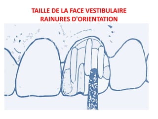 TAILLE DE LA FACE VESTIBULAIRE
RAINURES D'ORIENTATION
 