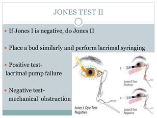 JONES TEST II
 If Jones I is negative, do Jones II
 Place a bud similarly and perform lacrimal syringing
 Positive test-
lacrimal pump failure
 Negative test-
mechanical obstruction
 