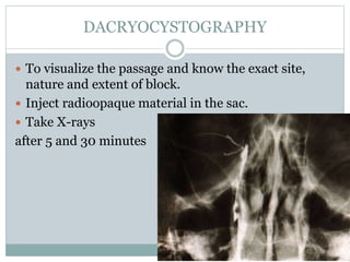 DACRYOCYSTOGRAPHY
 To visualize the passage and know the exact site,
nature and extent of block.
 Inject radioopaque material in the sac.
 Take X-rays
after 5 and 30 minutes
 