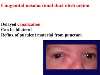 Congenital nasolacrimal duct obstruction
Delayed canalization
Can be bilateral
Reflux of purulent material from punctum
 