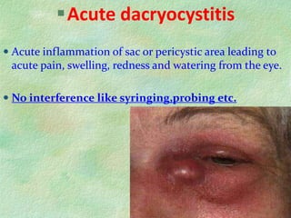 Acute dacryocystitis
 Acute inflammation of sac or pericystic area leading to
acute pain, swelling, redness and watering from the eye.
 No interference like syringing,probing etc.
 