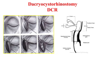 Dacryocystorhinostomy
DCR
 