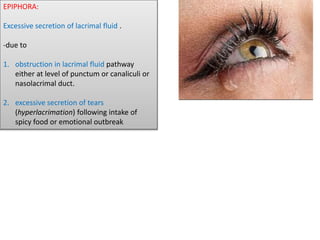 EPIPHORA:
Excessive secretion of lacrimal fluid .
-due to
1. obstruction in lacrimal fluid pathway
either at level of punctum or canaliculi or
nasolacrimal duct.
2. excessive secretion of tears
(hyperlacrimation) following intake of
spicy food or emotional outbreak
 