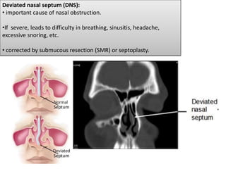 Deviated nasal septum (DNS):
• important cause of nasal obstruction.
•If severe, leads to difficulty in breathing, sinusitis, headache,
excessive snoring, etc.
• corrected by submucous resection (SMR) or septoplasty.
 