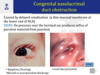 Nld Sign Lacrimal eyelids and conjunctivites_0.pdf