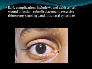  Early complications include wound dehiscence ,
wound infection, tube displacement, excessive
rhinostomy crusting , and intranasal synechiae.
 