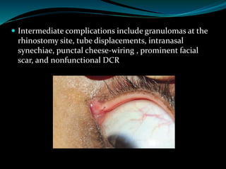  Intermediate complications include granulomas at the
rhinostomy site, tube displacements, intranasal
synechiae, punctal cheese-wiring , prominent facial
scar, and nonfunctional DCR
 