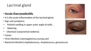 Lacrimal gland
• Acute Dacryoadenitis
• It is the acute inflammation of the lacrimal gland.
• Sign and symptoms.
• Painfull swelling in upper outer angle of orbit..
• Watering.
• Chemosis (conjunctival oedema).
• Cause:
• Viral infection( cytomegalovirus,mumps,etc)
• Bacterial infection( staphylococcus, streptococcus, gonococcus)
 