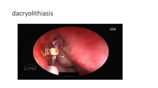 dacryolithiasis
 