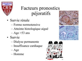 Facteurs pronostics  péjoratifs Survie rénale Forme normotensive Atteinte histologique aiguë Age >53 ans Survie Dialyse permanente Insuffisance cardiaque Age Homme 