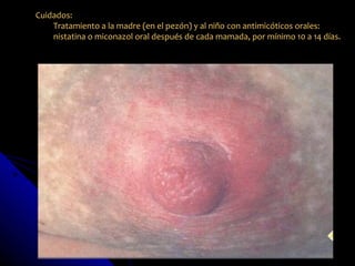 Cuidados:
    Tratamiento a la madre (en el pezón) y al niño con antimicóticos orales:
    nistatina o miconazol oral después de cada mamada, por mínimo 10 a 14 días.
 