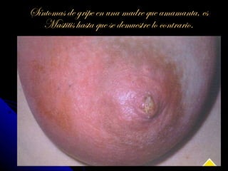 Síntomas de gripe en una madre que amamanta, es
   Mastitis hasta que se demuestre lo contrario.
 