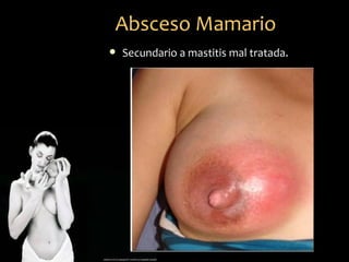 Absceso Mamario
   Secundario a mastitis mal tratada.
 