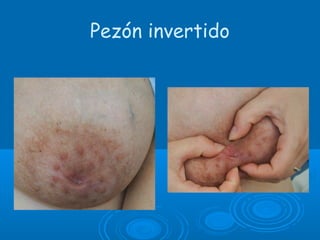 Pezón invertido
 