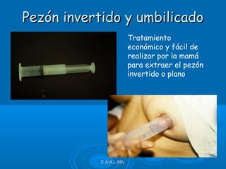 C.A.A.L.MA.C.A.A.L.MA.
Pezón invertido y umbilicadoPezón invertido y umbilicado
Tratamiento
económico y fácil de
realizar por la mamá
para extraer el pezón
invertido o plano
 